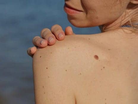What You Can Expect Before, During, and After Mole Removal