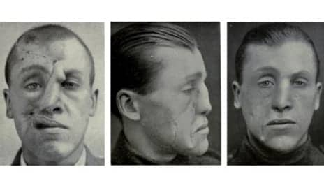 Innovative Cosmetic Surgery Restored WWI Vets’ Ravaged Faces—And Lives