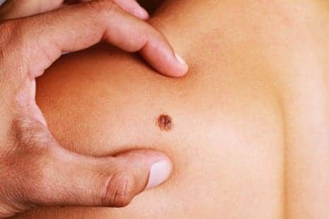 51 Things Dermatologists Need You to Know About Skin Cancer