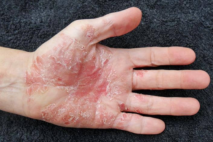 Stigma An Additional Burden for Many with Psoriasis