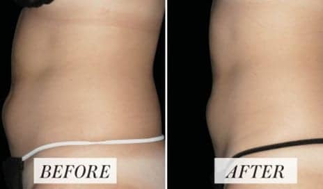 What Is Emsculpt?