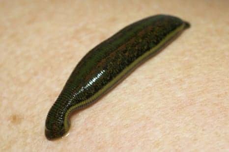When Leeches Are Used in Modern Medicine: Have We Turned Back Time?