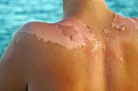 Can You Ever Reverse Sun Damage?
