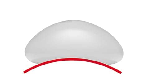 IDEAL IMPLANT Developed as a Solution to Address 'Silent Rupture'