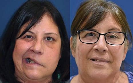 What’s In a Smile? A Lot More Than An Oregon Woman Thought After Stroke