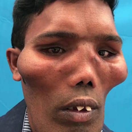 ‘Lion Faced’ Man Transformed as Surgeons Rebuild His Face in Life-Changing Operation