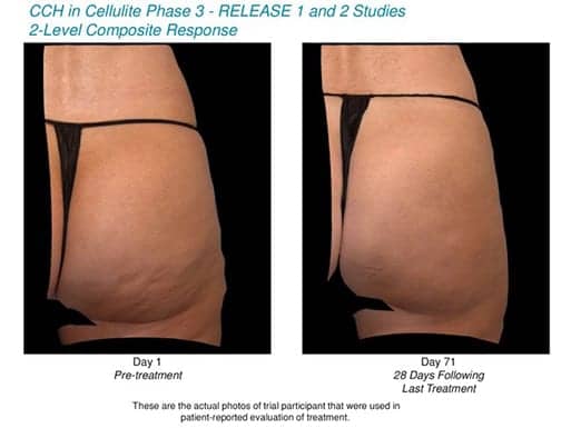 Endo Reports Positive Results from CCH Use to Treat Cellulite