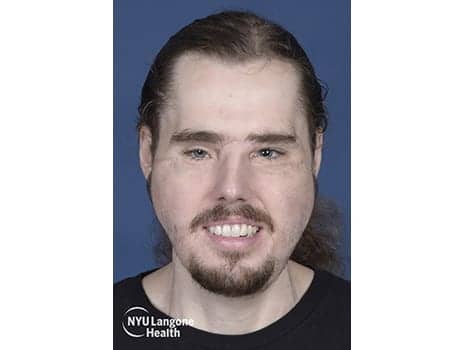 NYU Langone Health Performs Its Second Face Transplant
