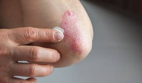 Why Dermatologists Are So Excited for This New Psoriasis Drug