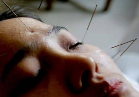 What Exactly Is Cosmetic Facial Acupuncture?