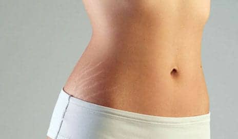 3 Common Methods For Stretch Mark Treatment