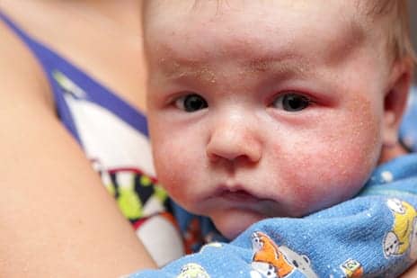 Eczema Kids' Moms Report Sleep Troubles