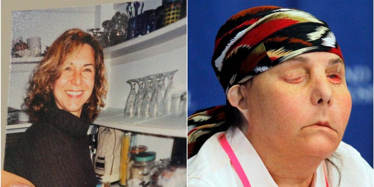 A Woman Received a Face Transplant After Domestic Violence Left Her Severely Disfigured. Now 6 Years Later, Her Body is Rejecting Her New Face