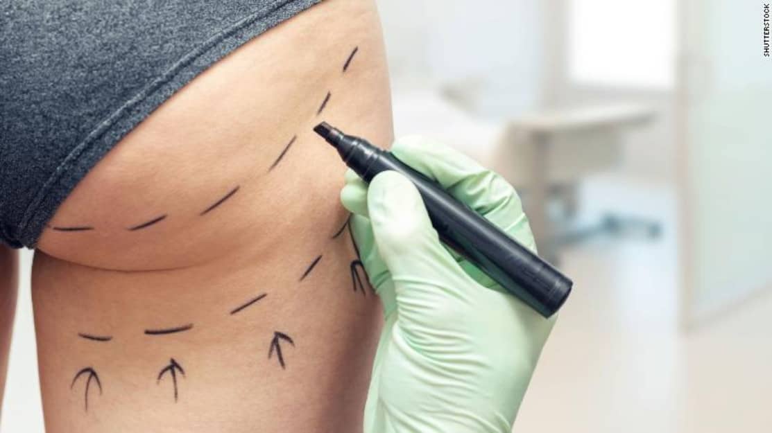 UK Plastic Surgeons to Vote on Banning ‘Kim Kardashian-Inspired’ Brazilian Butt Lifts Over Safety Fears