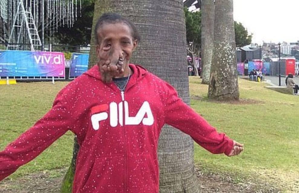 Young Woman Suffering from Rare Genetic Disorder Causing Massive Tumors to Grow on Her Face is Freed from Her ‘Life of Shame’ by Australian Surgeons