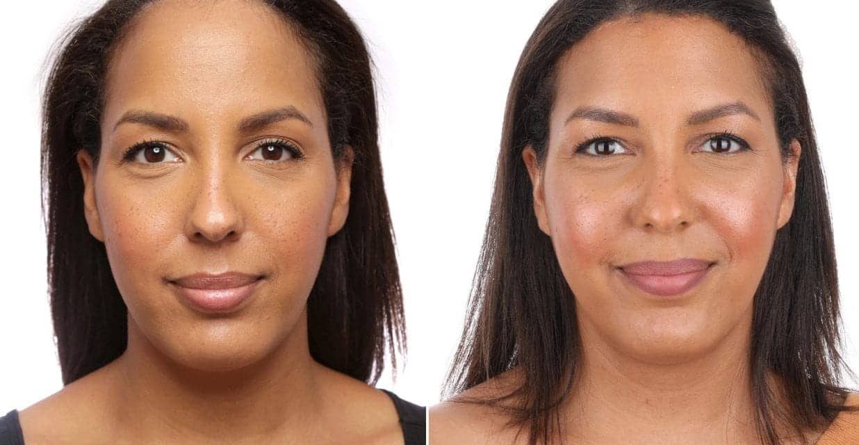 Mom Surgically Shrinks Forehead After Ponytail Caused Hairline to Recede