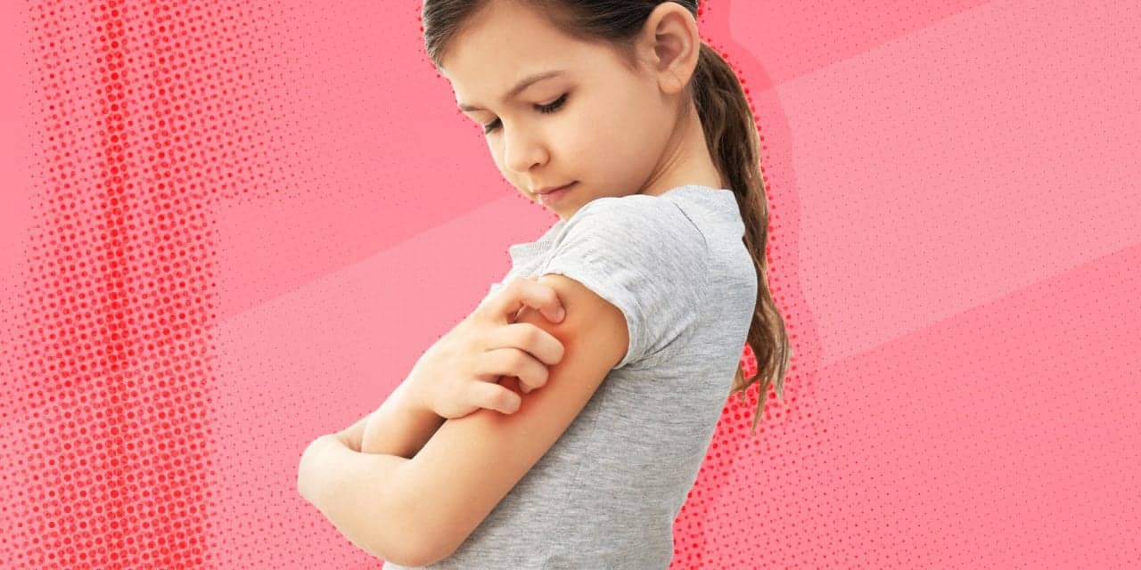 Helping Your Child Deal with Eczema