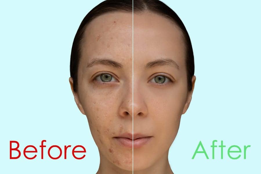 Why You Should Never Attempt A Professional-Grade Chemical Peel At Home