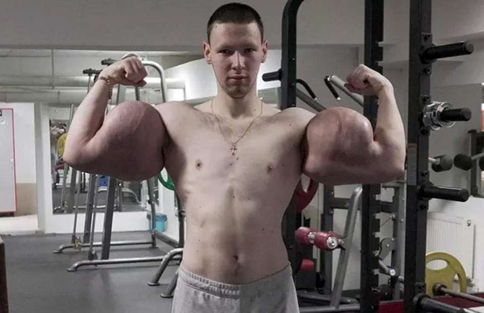 Russian ‘Popeye’ Has Life-Saving Surgery to Remove Chemicals from His Biceps