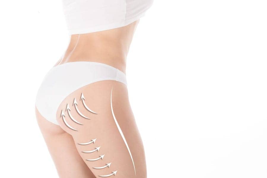 Brazilian Butt Lift Is Here to Stay