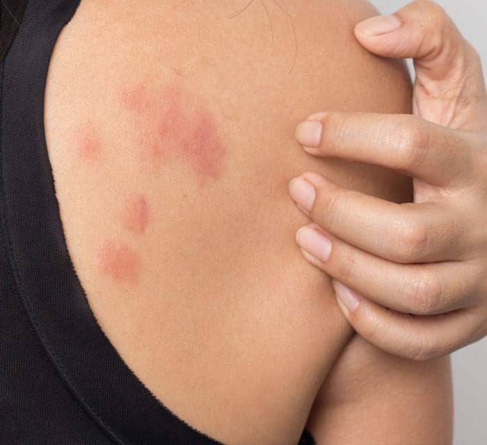 What to Do When Stress Gives You Hives