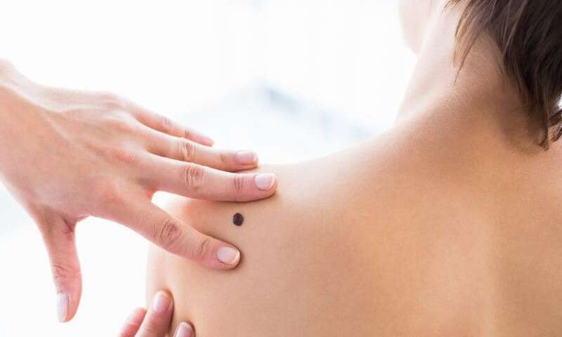 2012 to 2014 Saw 41,185 U.S. Patients with Skin Malignancy