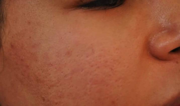 I Got Filler To Reduce My Acne Scarring — Here Are The Results