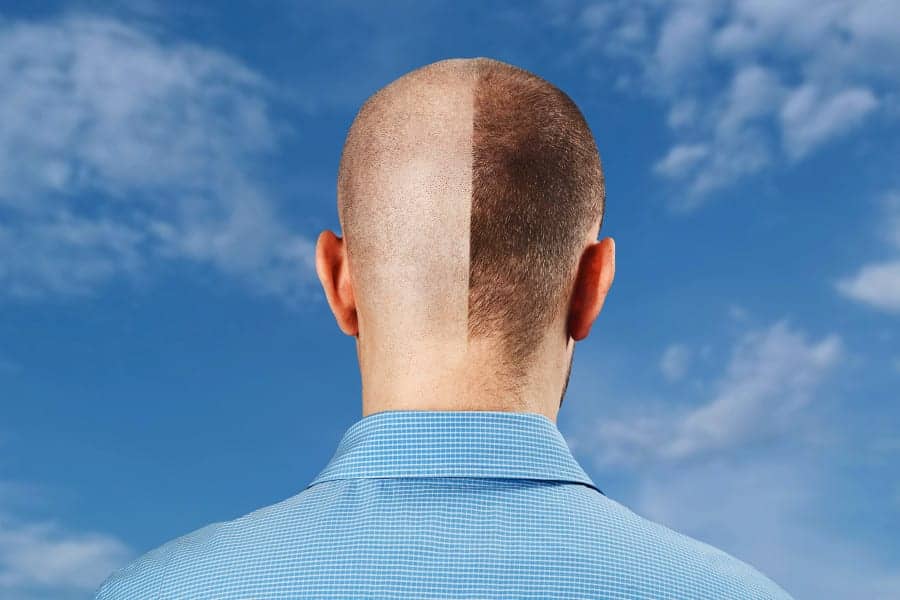 Every 13th Man Has a Hair Transplant According to Bookimed Study