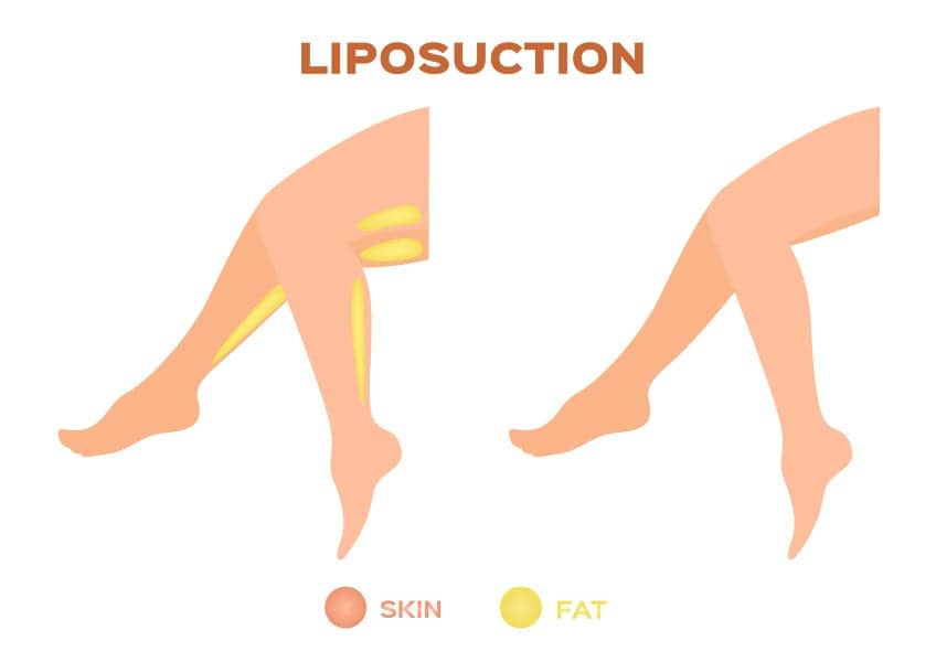 Treating Lipedema With Liposuction May Help Women With ‘Painful Fat’ Disease
