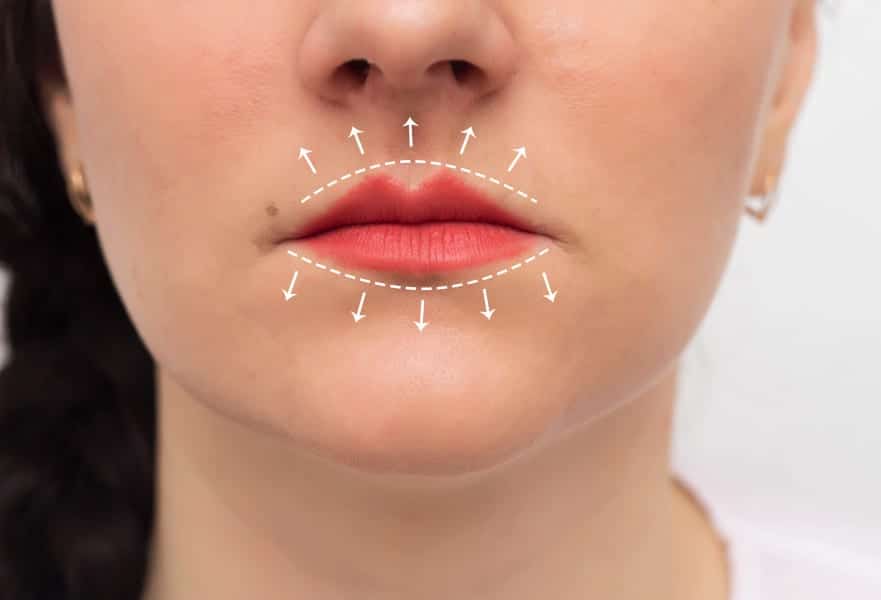 To Flip or to Lift: The Newest Ways to Get Fuller Lips