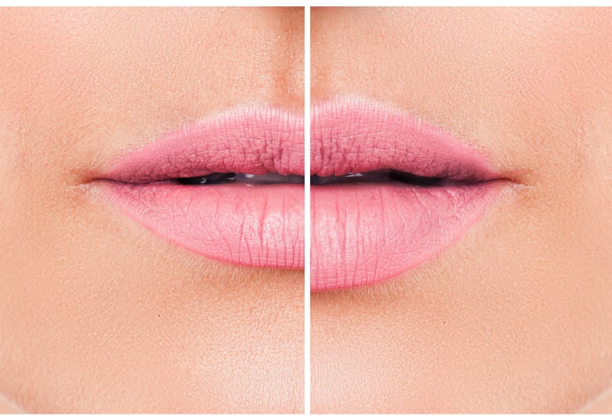 Lip Implants vs Injected Lip Fillers