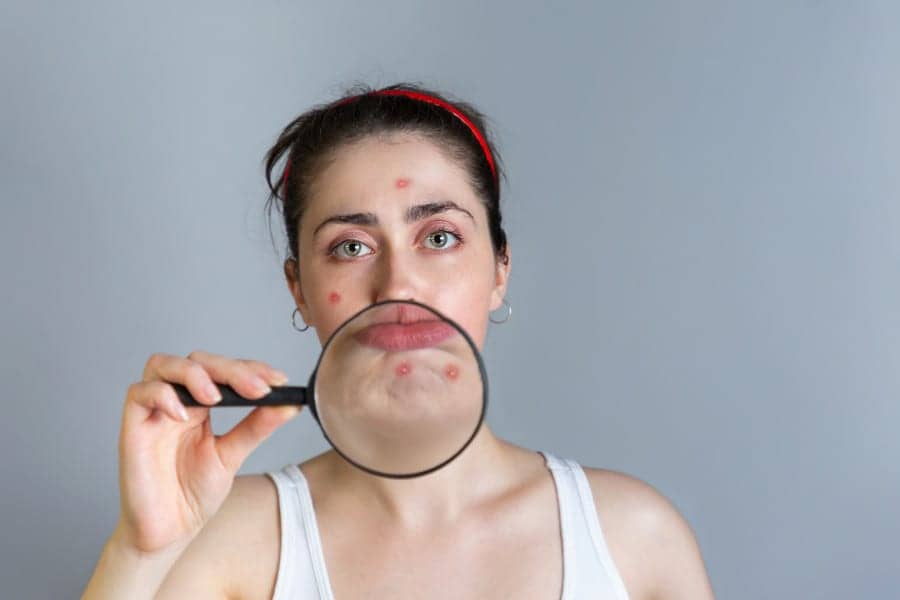 Do You Have Persistent Chin Acne? It Could Actually Be Perioral Dermatitis