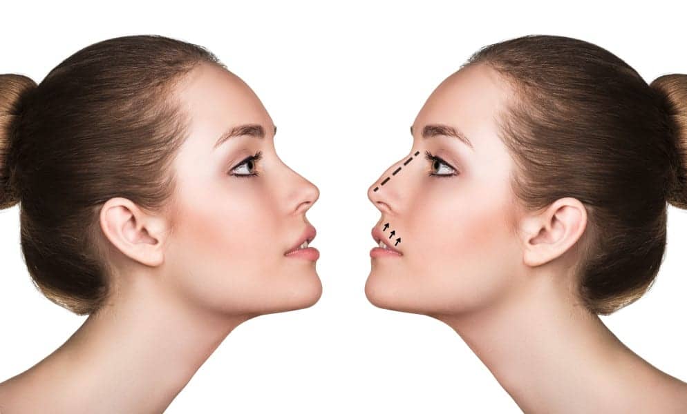 All About Alarplasty: Procedure, Cost, and Recovery