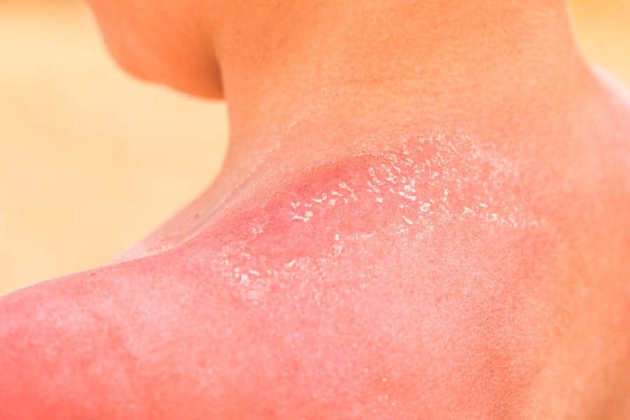 8 Reasons Why Your Skin Is Peeling—and How to Deal