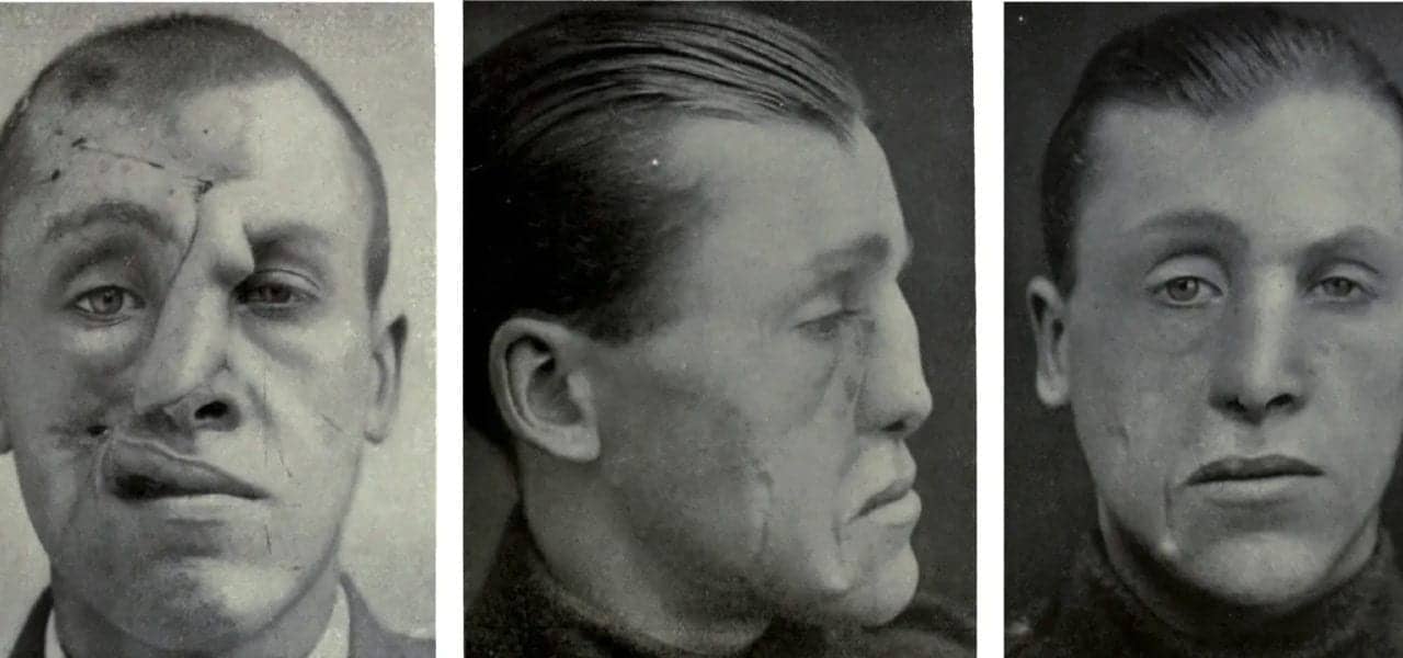 Dental School Surgeon Explores Link Between WWI Facial Trauma and Modern Plastic Surgery