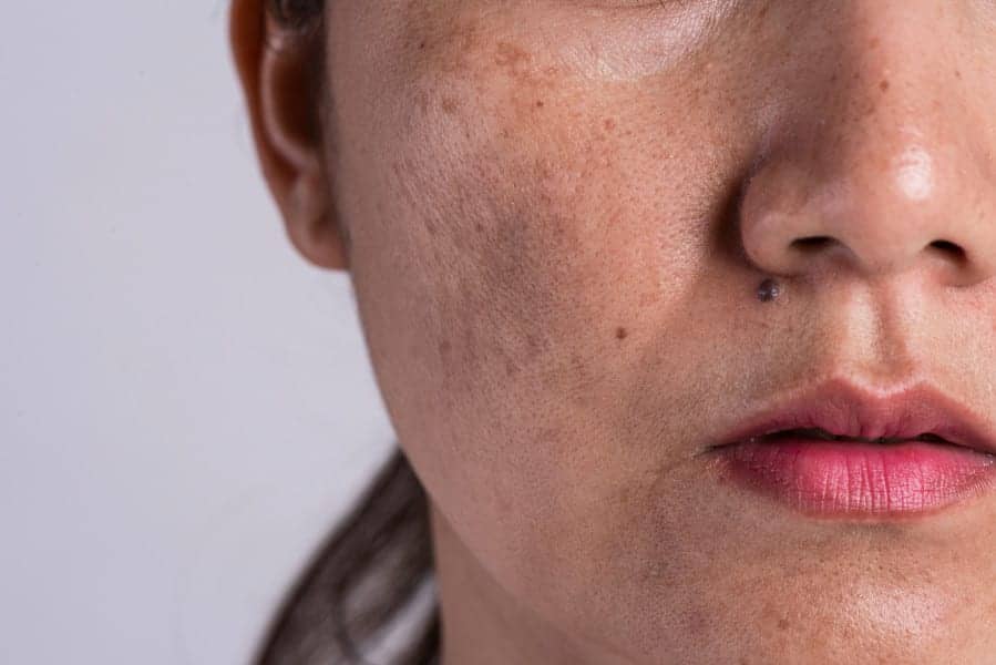 Derm-Approved Ways to Get Rid of Dark Spots on Every Skin Tone