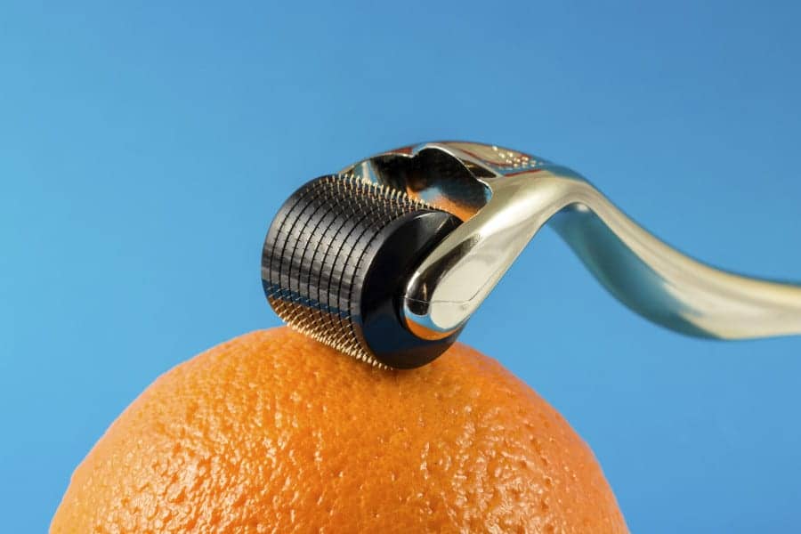 Microneedling Improves Skin Appearance with Little Downtime