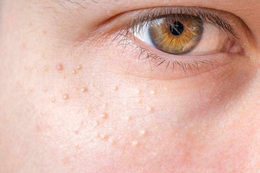 What Are Milia, Those Tiny White Dots on Your Skin—and How Can You Get Rid of Them?