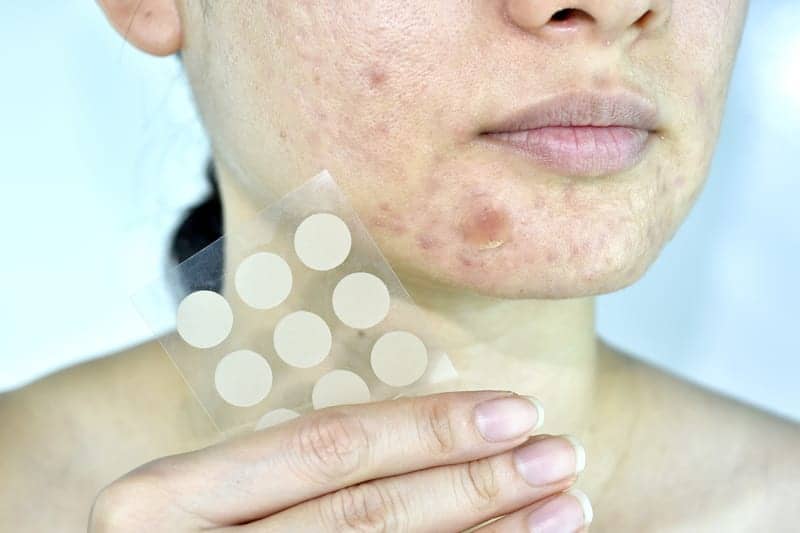 Do Those Pimple Stickers Actually Work?
