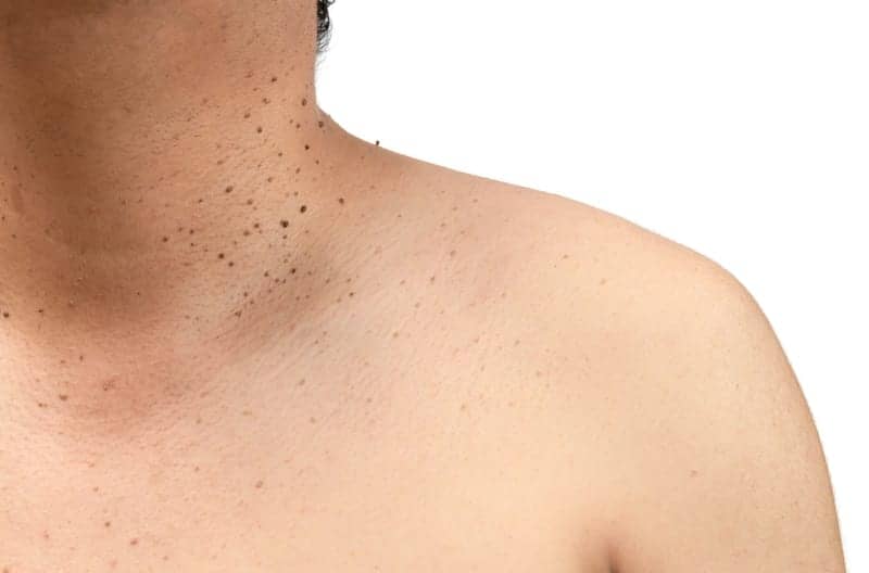 What Causes Skin Tags—and How to (Finally) Get Rid of Them