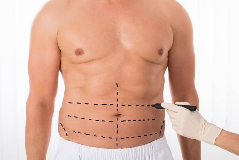 Tummy Tuck Growing in Popularity Among Men