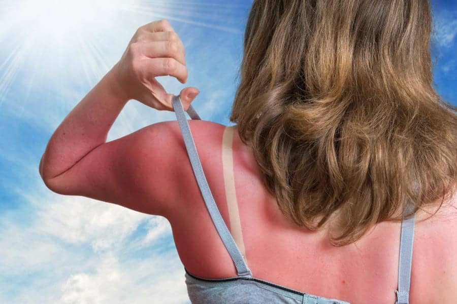 Itchy Sunburn? Here's How To Relieve Hell's Itch