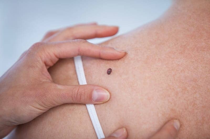 Coronavirus Quarantine Causing Some to Remove Moles, Skin Tags at Home; Dermatologists Warn This is Unsafe