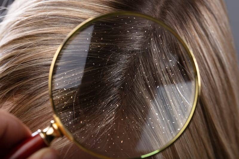 All the Reasons You Might Be Experiencing Dandruff for the First Time, According to Experts