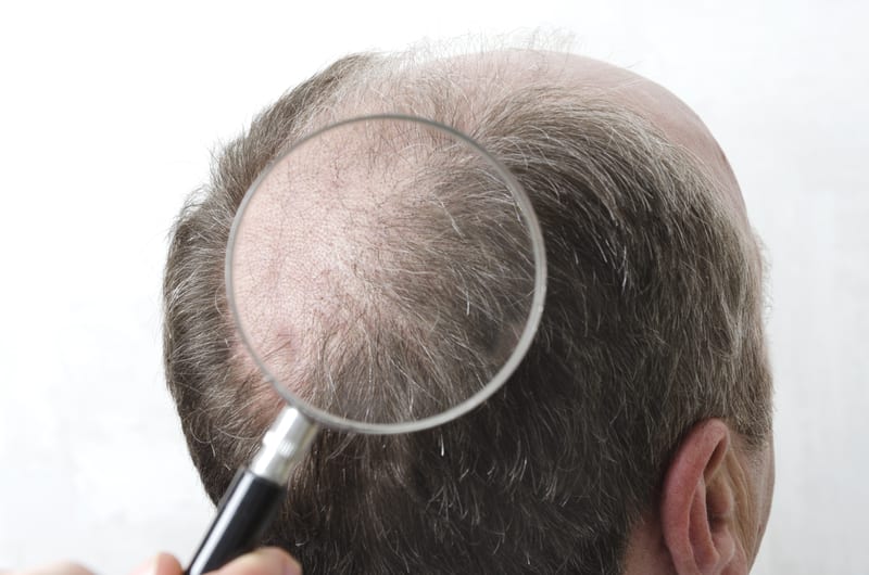 Bald Men At Higher Risk Of Severe Coronavirus Symptoms, Per Study