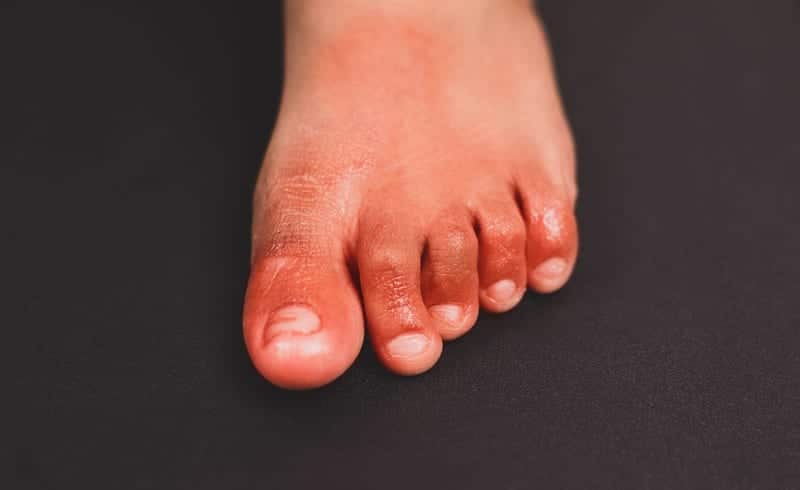 ‘COVID Toe’ Probably Not Caused by COVID-19