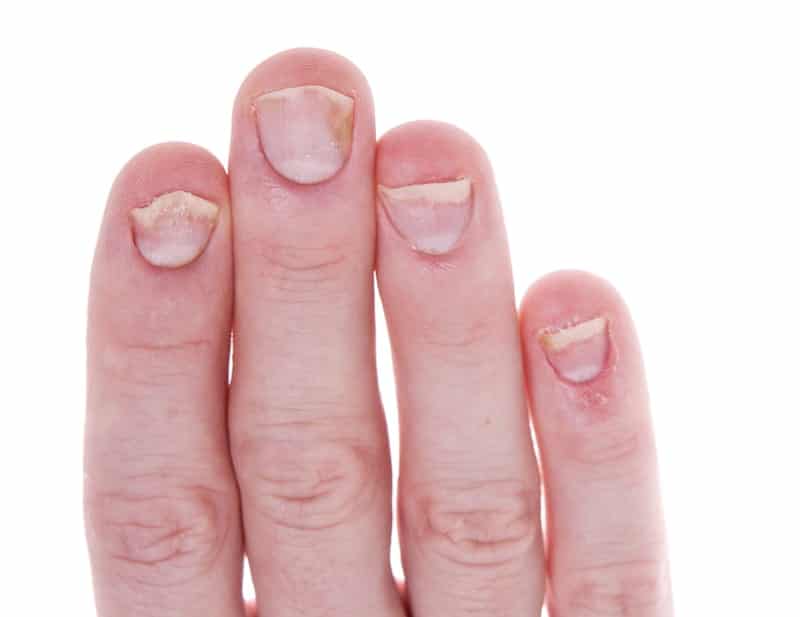 Improve Nail Psoriasis at Home with These Tips Plastic Surgery Practice