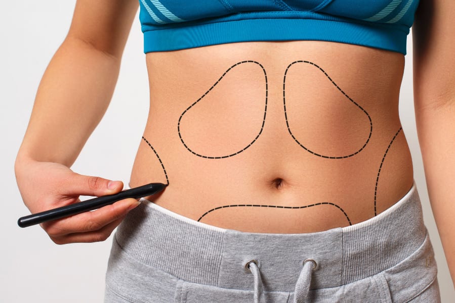 6 Plastic Surgeons Reveal the Biggest Misconceptions Patients Have About Liposuction