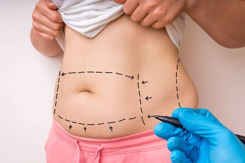 Here’s the Thing, You Have to Do Your Part for a Tummy Tuck