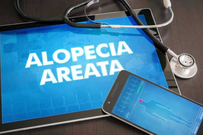 Pediatric Alopecia Areata Correlates With Autoimmune and Metabolic Disorders